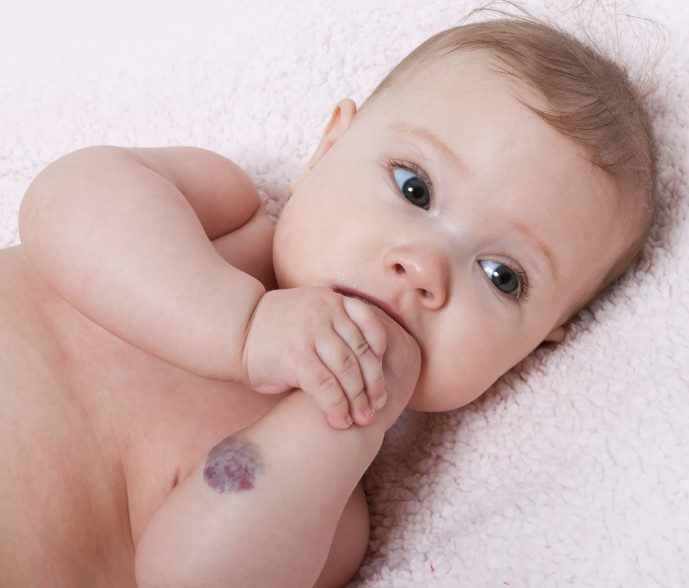 hemangioma infantil tem cura