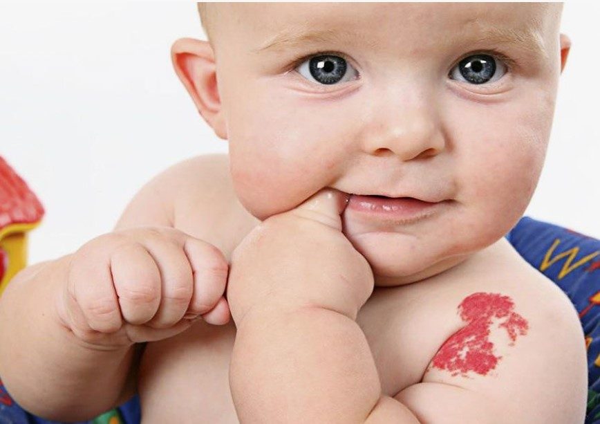 hemangioma em bebês