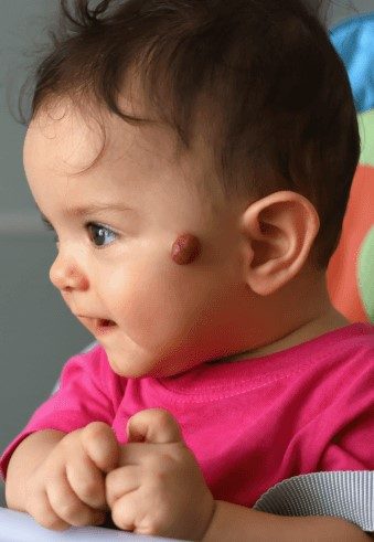 hemangioma em crianças