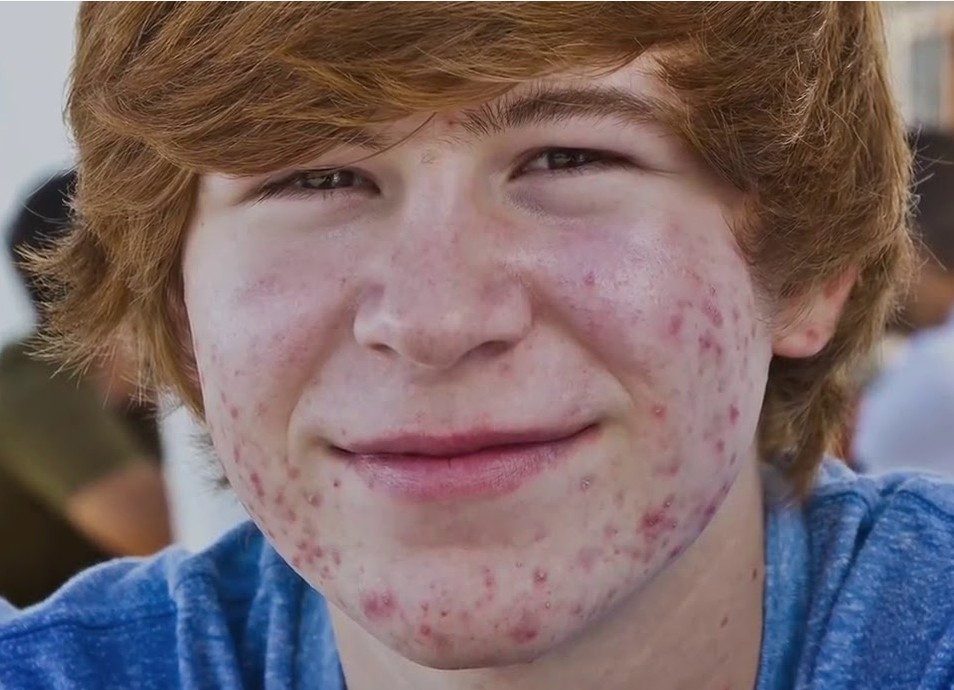 acne na adolescencia