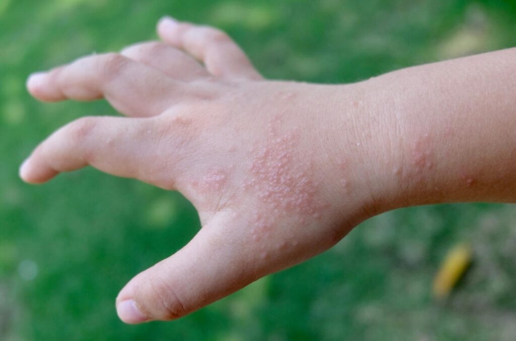 desidrose na mão em criança